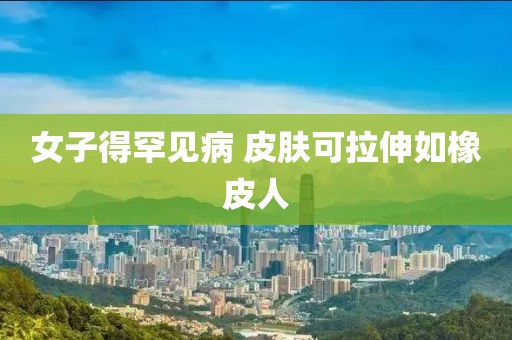 女子得罕见病 皮肤可拉伸如橡皮人